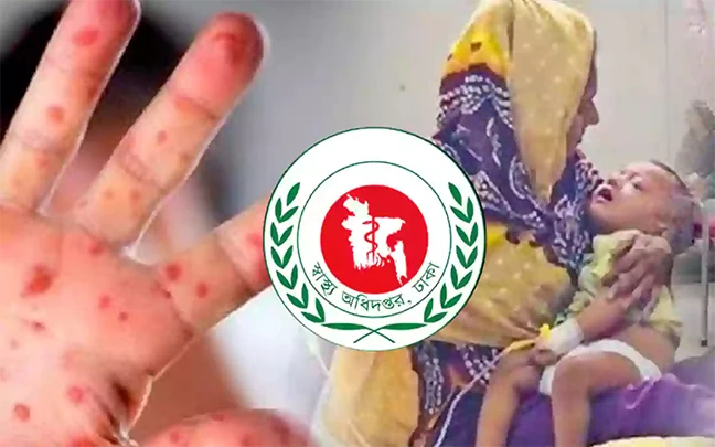 হাম ও উপসর্গে আরও ৬ শিশুর মৃত্যু