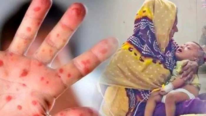 আরও ৭ জনের প্রাণ গেল হামের উপসর্গে, মোট মৃত্যু ৬০০ ছাড়াল